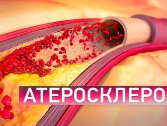 Атеросклероз можно профилактировать