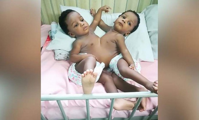 В Нигерии команда из 78 врачей успешно разделила сиамских близнецов