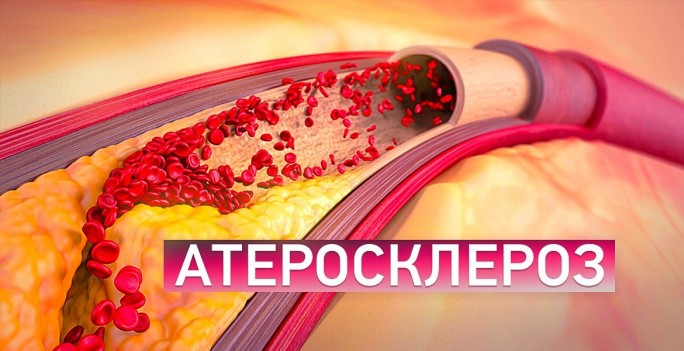 Атеросклероз можно профилактировать